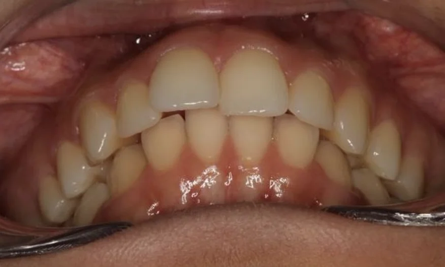 TRATAMIENTO ORTODONCIA INVISALIGN FULL 24 MESES. 2 parte