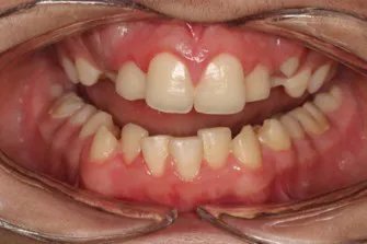 brackets antes 01