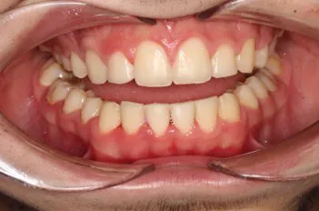 brackets después 01