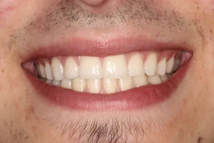 brackets después 02