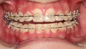 brackets durante 01