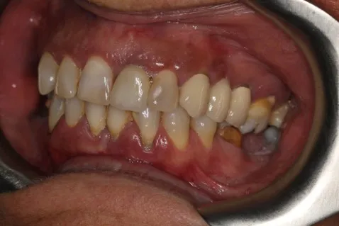 casos456 antes 03