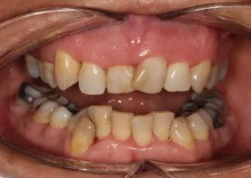 ortodoncia brackets antes