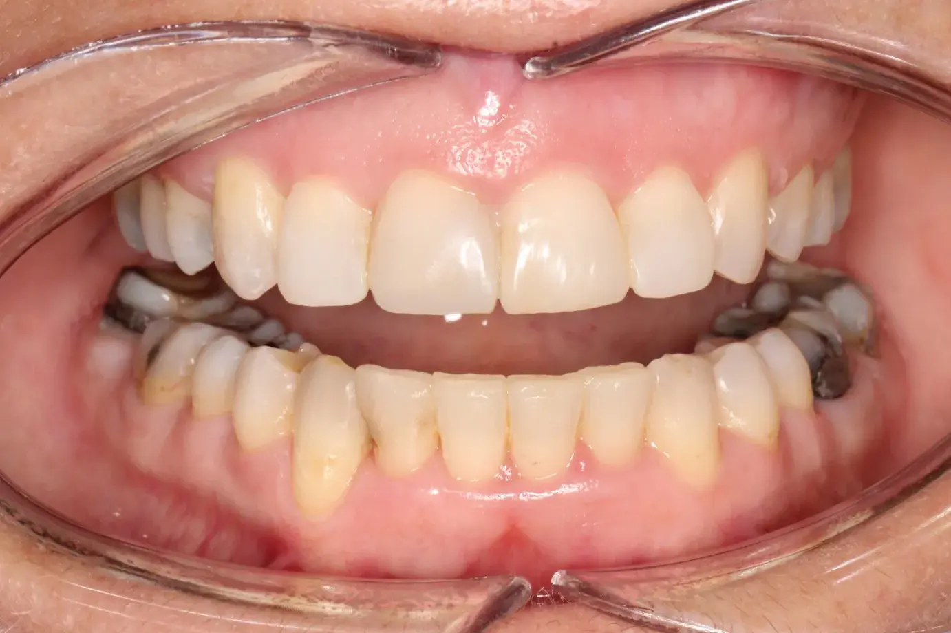 ortodoncia brackets despues