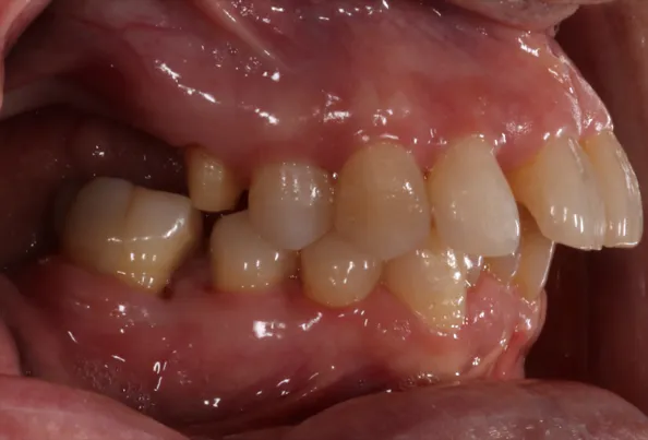 ortodoncia invisalign 02 antes