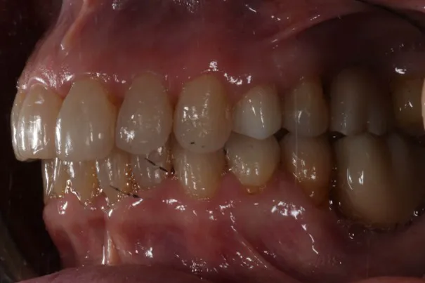 ortodoncia invisalign 02 despues