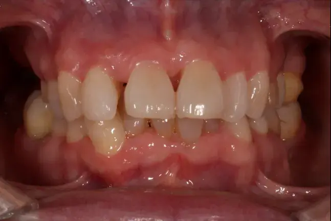 ortodoncia invisalign antes