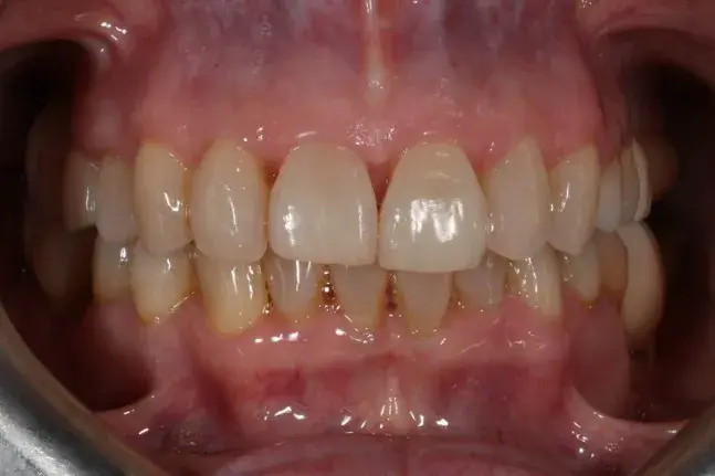ortodoncia invisalign despues