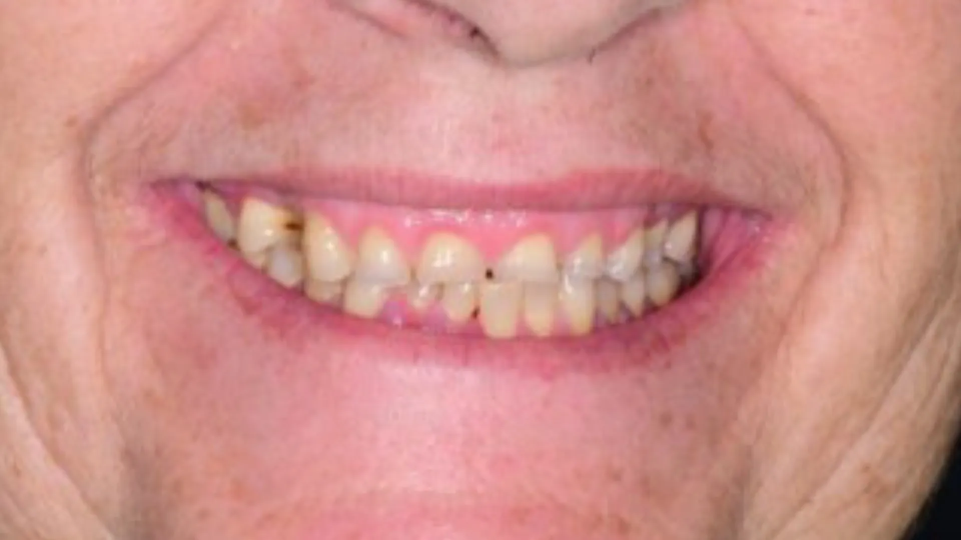 Antes
