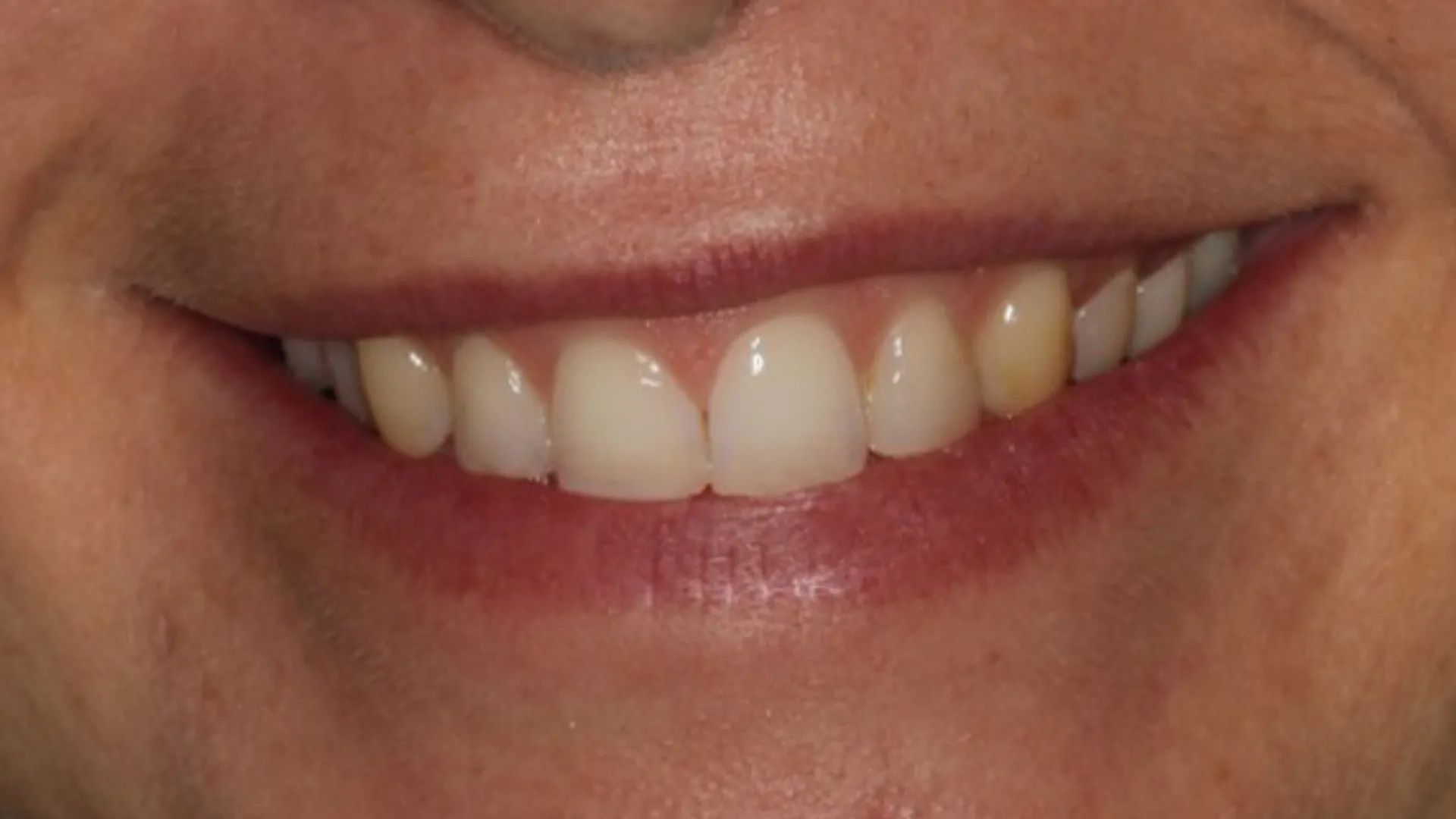Antes